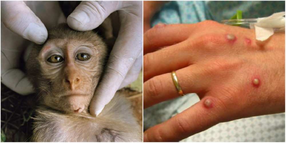 variola maimutei raspandire in toata lumea